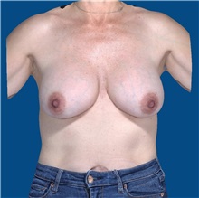 Breast Implant Removal Before Photo by Trent Douglas, MD; Greenbrae, CA - Case 35920