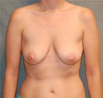 Breast Augmentation Before Photo by Delio Ortegon, MD; San Antonio, TX - Case 20867