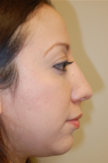 Rhinoplasty After Photo by Delio Ortegon, MD; San Antonio, TX - Case 20874