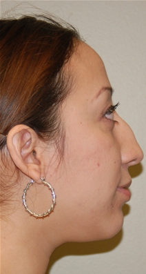 Rhinoplasty Before Photo by Delio Ortegon, MD; San Antonio, TX - Case 20874