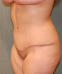 Tummy Tuck After Photo by Delio Ortegon, MD; San Antonio, TX - Case 20877