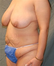 Tummy Tuck Before Photo by Delio Ortegon, MD; San Antonio, TX - Case 20877