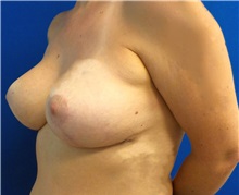 Breast Augmentation After Photo by Ankit Desai, MD; Jacksonville, FL - Case 34042