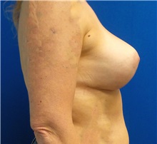 Breast Augmentation After Photo by Ankit Desai, MD; Jacksonville, FL - Case 34042