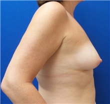 Breast Reconstruction Before Photo by Ankit Desai, MD; Jacksonville, FL - Case 34060
