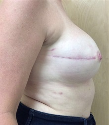 Breast Reconstruction After Photo by Ankit Desai, MD; Jacksonville, FL - Case 34064