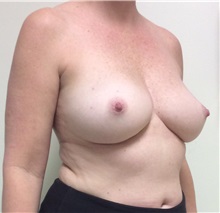 Breast Reconstruction Before Photo by Ankit Desai, MD; Jacksonville, FL - Case 34064