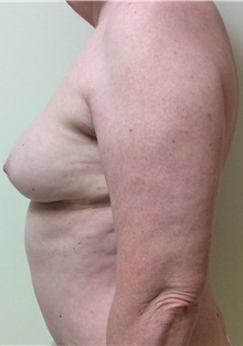 Breast Reconstruction After Photo by Ankit Desai, MD; Jacksonville, FL - Case 34066