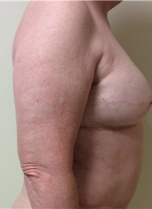 Breast Reconstruction After Photo by Ankit Desai, MD; Jacksonville, FL - Case 34066
