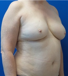Breast Reconstruction Before Photo by Ankit Desai, MD; Jacksonville, FL - Case 34066