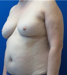 Breast Reconstruction Before Photo by Ankit Desai, MD; Jacksonville, FL - Case 34066
