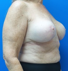 Breast Augmentation After Photo by Ankit Desai, MD; Jacksonville, FL - Case 34068