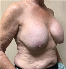 Breast Augmentation Before Photo by Ankit Desai, MD; Jacksonville, FL - Case 34068
