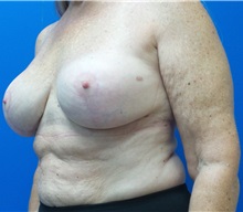 Breast Augmentation After Photo by Ankit Desai, MD; Jacksonville, FL - Case 34068