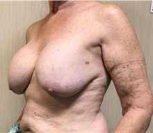 Breast Augmentation Before Photo by Ankit Desai, MD; Jacksonville, FL - Case 34068