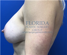 Breast Augmentation After Photo by Ankit Desai, MD; Jacksonville, FL - Case 34193