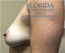 Breast Augmentation Before Photo by Ankit Desai, MD; Jacksonville, FL - Case 34193
