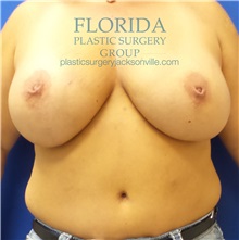 Breast Reconstruction Before Photo by Ankit Desai, MD; Jacksonville, FL - Case 34636