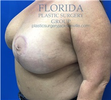 Breast Reconstruction After Photo by Ankit Desai, MD; Jacksonville, FL - Case 34636