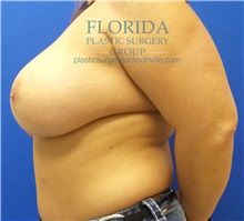 Breast Reconstruction Before Photo by Ankit Desai, MD; Jacksonville, FL - Case 34636