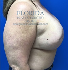 Breast Reconstruction After Photo by Ankit Desai, MD; Jacksonville, FL - Case 34636