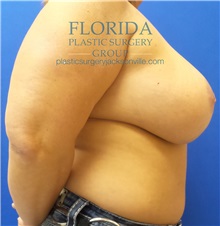 Breast Reconstruction Before Photo by Ankit Desai, MD; Jacksonville, FL - Case 34636