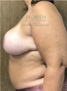 Breast Reconstruction After Photo by Ankit Desai, MD; Jacksonville, FL - Case 34650