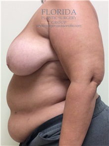 Breast Reconstruction Before Photo by Ankit Desai, MD; Jacksonville, FL - Case 34650
