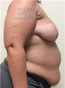 Breast Reconstruction Before Photo by Ankit Desai, MD; Jacksonville, FL - Case 34650