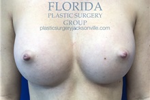 Breast Augmentation After Photo by Ankit Desai, MD; Jacksonville, FL - Case 34652