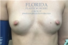 Breast Augmentation Before Photo by Ankit Desai, MD; Jacksonville, FL - Case 34652