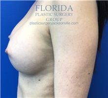Breast Augmentation After Photo by Ankit Desai, MD; Jacksonville, FL - Case 34652