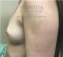 Breast Augmentation Before Photo by Ankit Desai, MD; Jacksonville, FL - Case 34652
