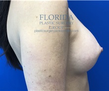 Breast Augmentation After Photo by Ankit Desai, MD; Jacksonville, FL - Case 34652