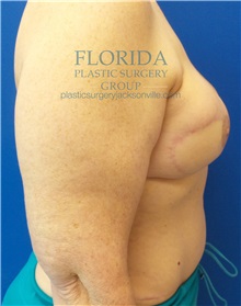 Breast Reconstruction After Photo by Ankit Desai, MD; Jacksonville, FL - Case 35668