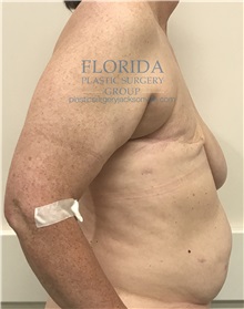 Breast Reconstruction Before Photo by Ankit Desai, MD; Jacksonville, FL - Case 35668