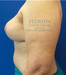 Breast Reconstruction After Photo by Ankit Desai, MD; Jacksonville, FL - Case 35668