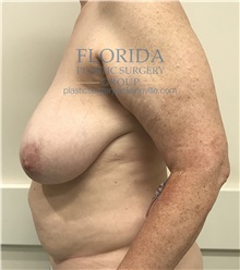 Breast Reconstruction Before Photo by Ankit Desai, MD; Jacksonville, FL - Case 35668