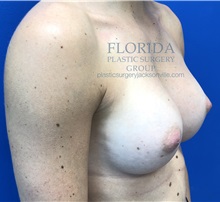 Breast Augmentation After Photo by Ankit Desai, MD; Jacksonville, FL - Case 35670