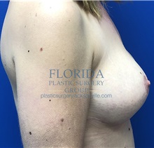 Breast Lift After Photo by Ankit Desai, MD; Jacksonville, FL - Case 35703