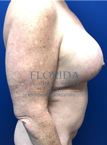 Tummy Tuck After Photo by Ankit Desai, MD; Jacksonville, FL - Case 35866