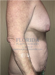 Tummy Tuck Before Photo by Ankit Desai, MD; Jacksonville, FL - Case 35866