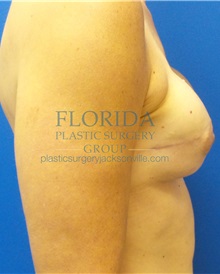 Breast Reconstruction After Photo by Ankit Desai, MD; Jacksonville, FL - Case 35867