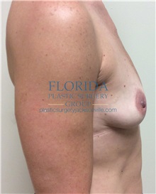 Breast Reconstruction Before Photo by Ankit Desai, MD; Jacksonville, FL - Case 35867