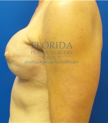 Breast Reconstruction After Photo by Ankit Desai, MD; Jacksonville, FL - Case 35867