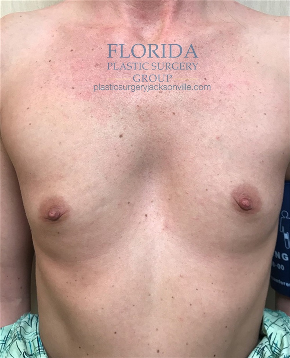 Breast Augmentation Before and After Photos by Ankit Desai MD