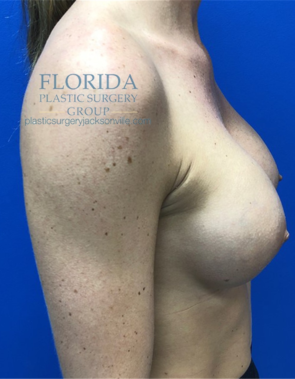 Breast Augmentation Before and After Photos by Ankit Desai MD