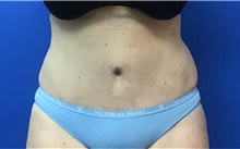 Tummy Tuck After Photo by Ankit Desai, MD; Jacksonville, FL - Case 38968