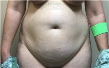 Tummy Tuck Before Photo by Ankit Desai, MD; Jacksonville, FL - Case 38968