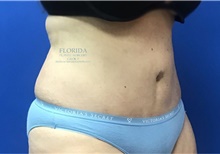 Tummy Tuck After Photo by Ankit Desai, MD; Jacksonville, FL - Case 38968